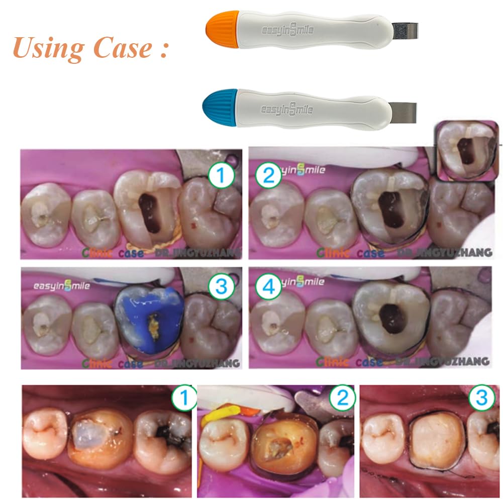 Easyin Smile Matrix Profecto Sectional Matrix Set (50pcs / set)
