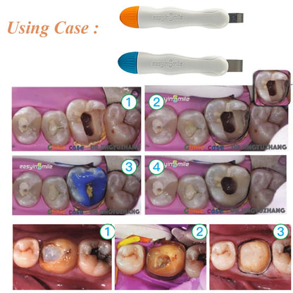 Easyin Smile Matrix Profecto Sectional Matrix Set (50pcs / set)